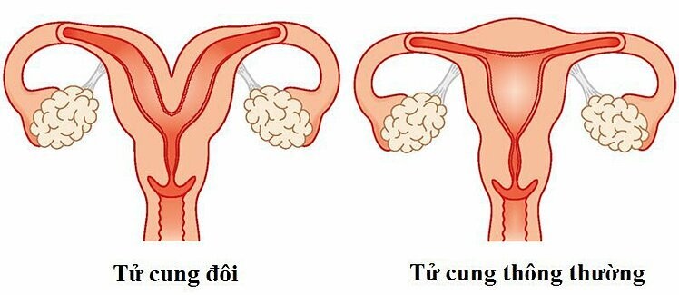 Hình ảnh tử cung thông thường và tử cung đôi.