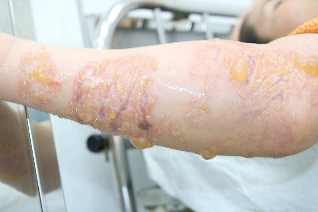 Da phồng rộp do chạm sứa biển