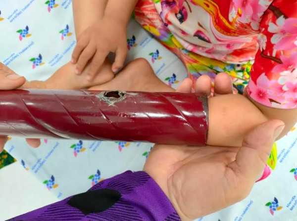 Bác sĩ giải cứu bé gái 3 tuổi kẹt tay trong chân giường sắt