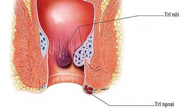 Điều trị trĩ phải ‘đi từ gốc’