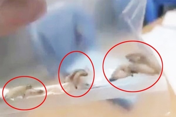 Hàng chục con giòi trong tai của ông L. được gắp ra ngoài