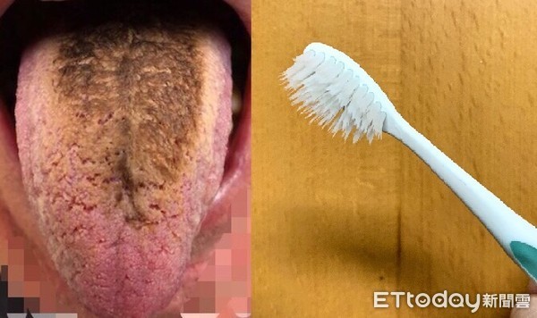 Lưỡi đen như bánh mì cháy, bác sĩ sốc hơn khi nhìn vào thực quản của người đàn ông này