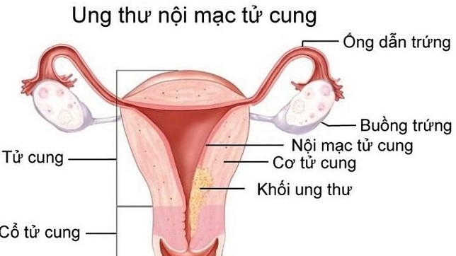 Bệnh nhẹ tiến triển thành ung thư do chủ quan