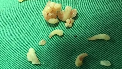 20 chiếc răng li ti trong một khối u