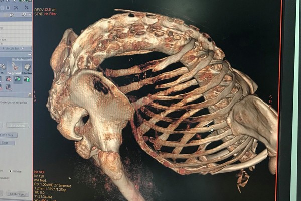 Anh T. cong gập người như tôm, cột sống gần như song song với trục xương đùi