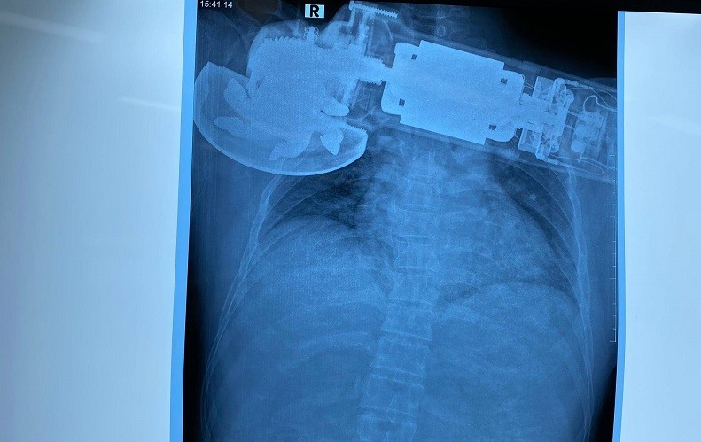 Máy chà cắm găm vào ngực phải của bệnh nhân.