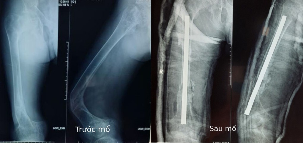 Hình ảnh chụp X-quang trước và sau khi mổ xếp xương. Ảnh: Bệnh viện cung cấp.