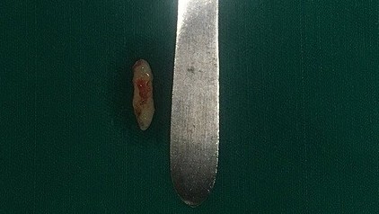 Răng mọc ngầm chọc thủng hốc mũi