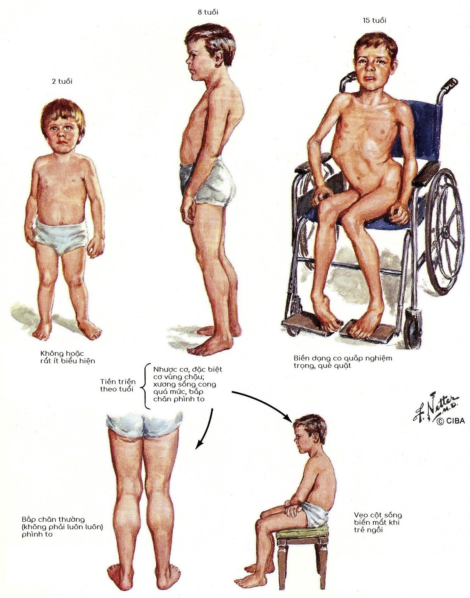 Bệnh nhân mắc loạn dưỡng cơ Duchenne
