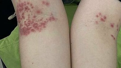 Bà mẹ tưởng chàm hóa bệnh tay chân miệng