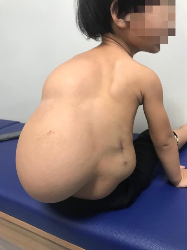 Mới 2 tuổi, bé V. đã phải cõng khối u hơn 4 kg gây biến dạng cột sống