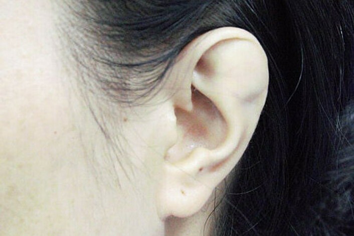 'Nhẹ cả người' khi thoát khỏi đôi tai dị tật