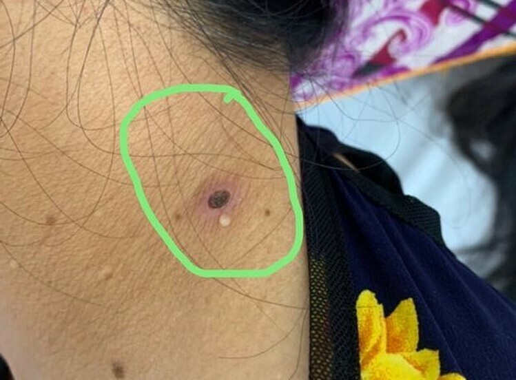 Suýt chết do sốt mò