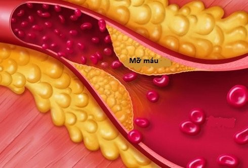 Bệnh mỡ máu di truyền 16 người một gia đình