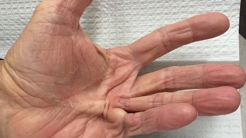 Co rút bàn tay do nghiện rượu