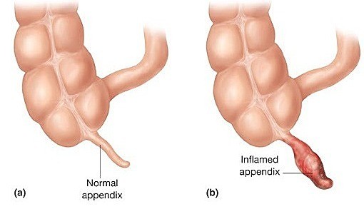 Viêm ruột thừa có cần mổ?