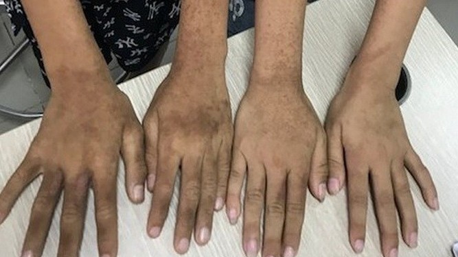 Em bé mắc bệnh viêm da cực hiếm