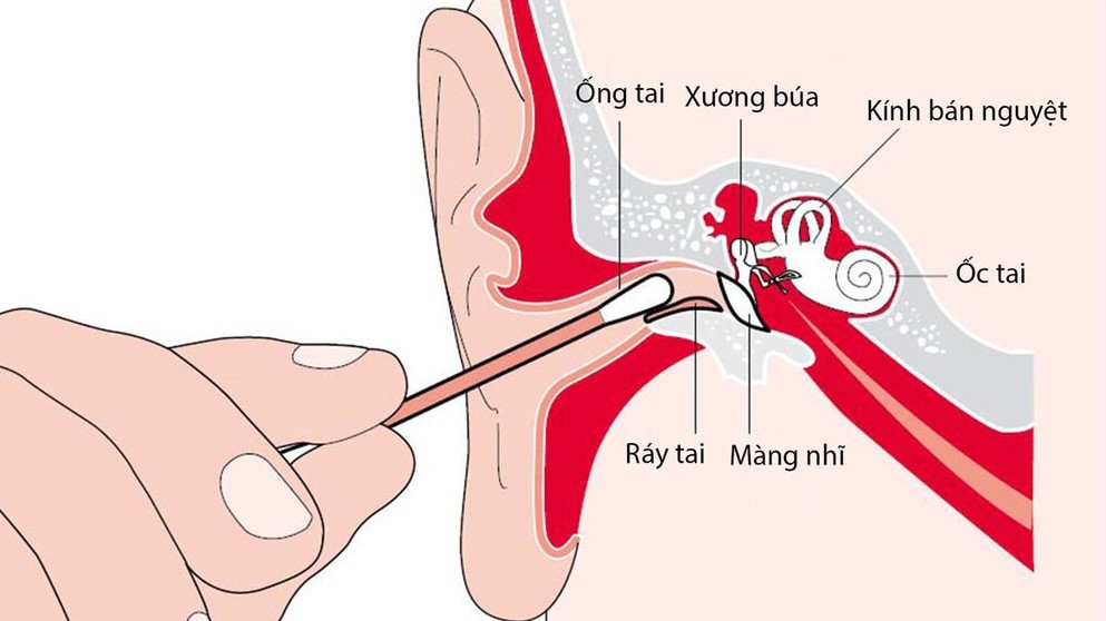 Bị nấm tai do lấy ráy ở tiệm cắt tóc