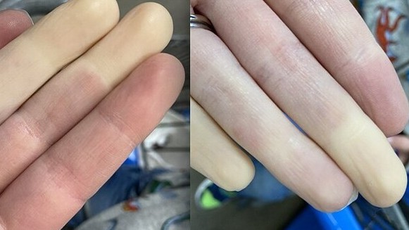 Bệnh mùa lạnh ngón tay trắng bệch
