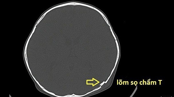 Bé trai ngã xe đạp lõm sọ