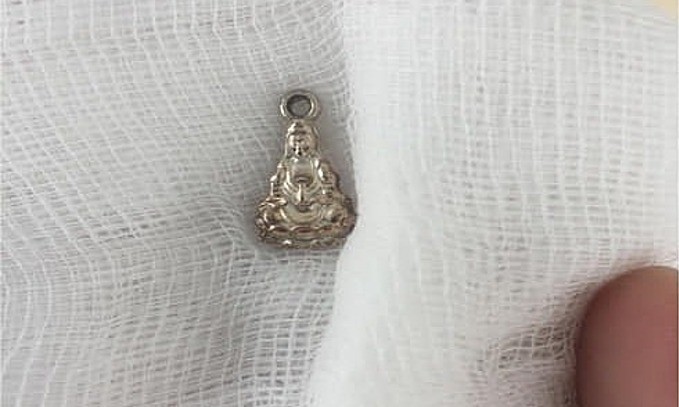 Mặt dây chuyền được lấy ra khỏi cơ thể bé gái. Ảnh do bệnh viện cung cấp.