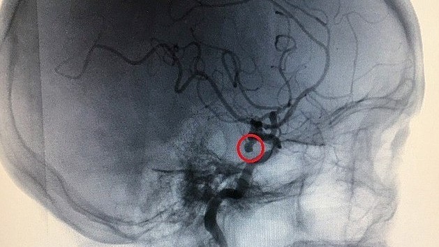 Túi phình mạch máu não - 'bom nổ chậm'
