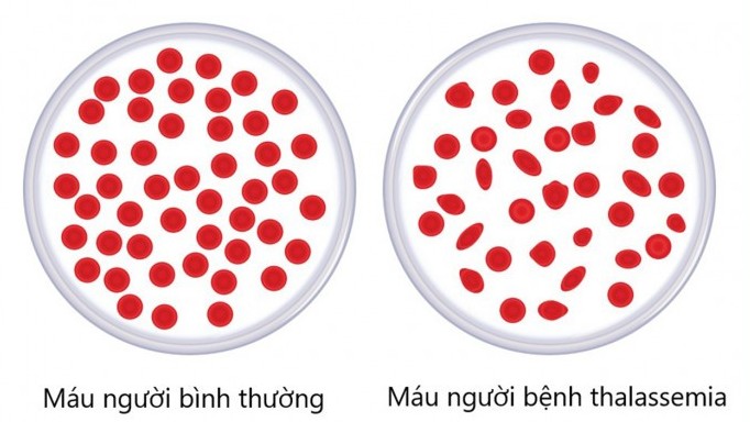 Làm thế nào để phát hiện sớm gene bệnh tan máu bẩm sinh?