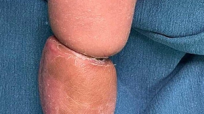 Tưởng bé bụ bẫm có ngấn hóa hội chứng vòng thắt bẩm sinh