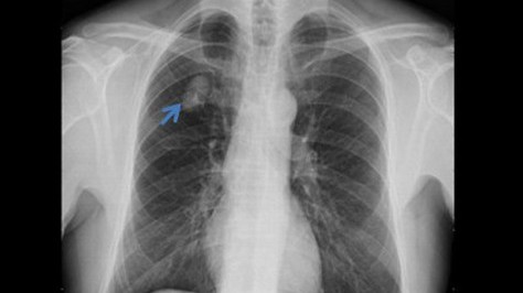 Người đàn ông phát hiện u phổi sau khi khám sức khỏe định kỳ