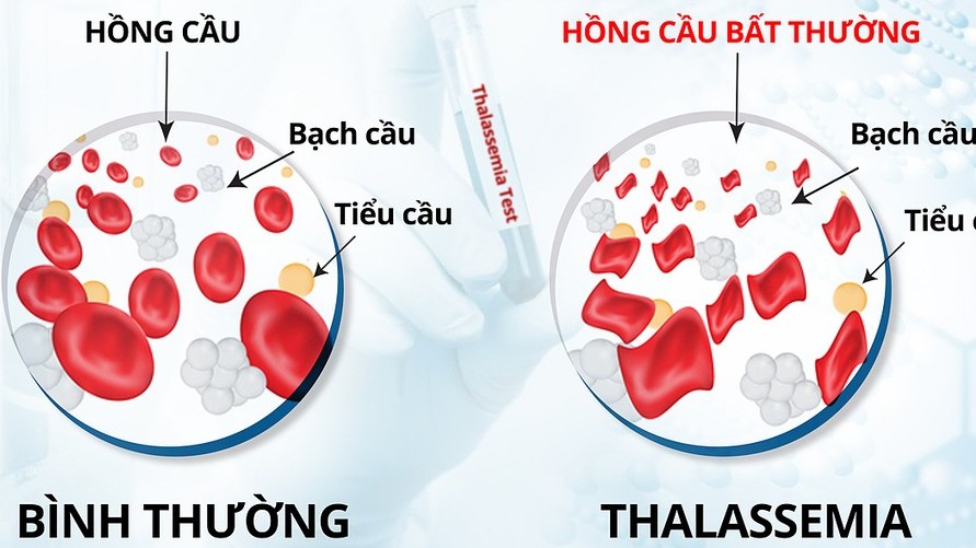 Hai ông cháu mắc bệnh Thalassemia