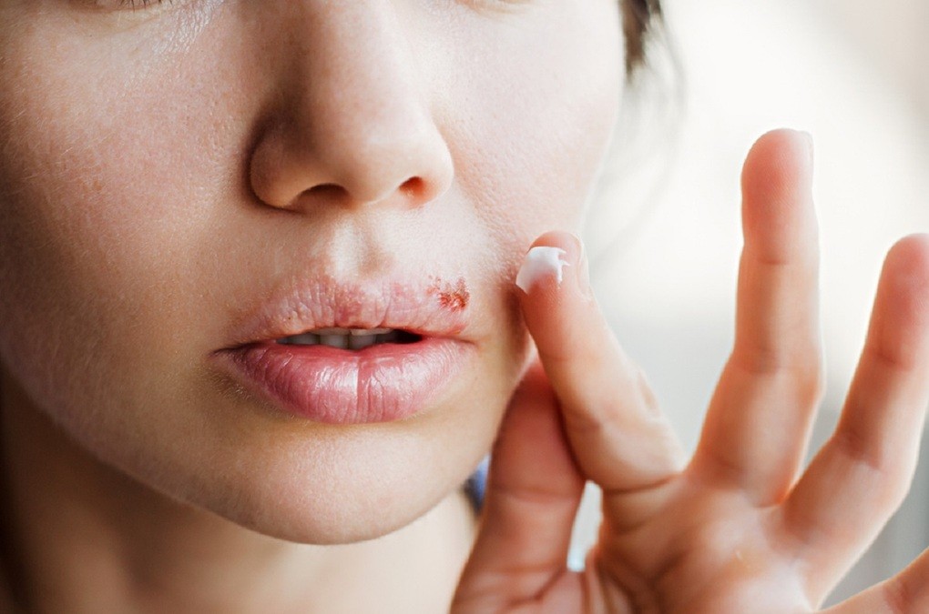 Cả mụn rộp miệng và sinh dục đều lây qua nụ hôn. Ảnh: Shutterstock