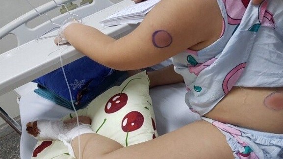 Bé 5 tuổi ở Quảng Bình nhiễm khuẩn Whitmore sau khi bị gà mổ