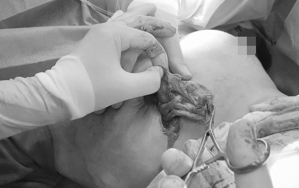 Miếng gạc y tế được rút ra khỏi ngực bệnh nhân. Ảnh do bệnh viện cung cấp.