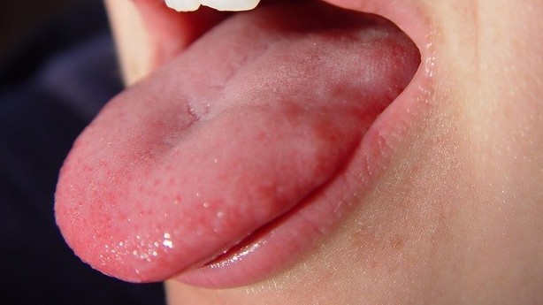 Ung thư lưỡi dễ nhầm viêm loét