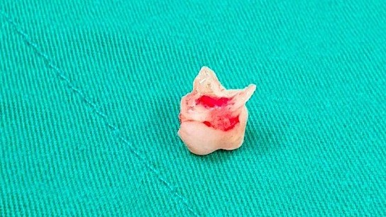 Chiếc răng sữa rơi vào phổi con khi được mẹ nhổ