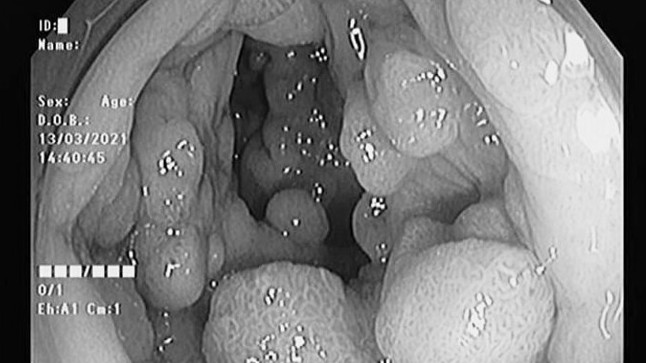 Hàng trăm polyp chen chúc trong đại trực tràng hai anh em