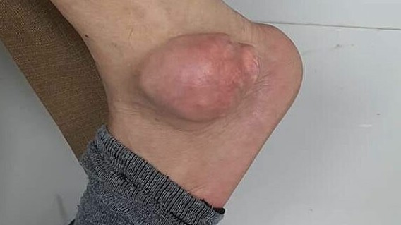 Chữa gout bằng 'thuốc nam', chân mọc u như quả ổi