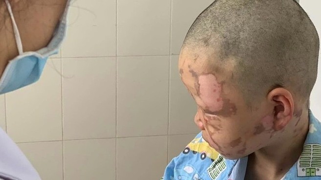 Bé trai tự đốt cồn bỏng mặt