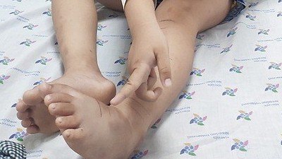Bé trai bị rắn lục cắn trong khi thả diều