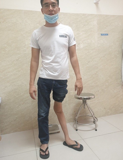 Bệnh nhân trước khi phẫu thuật điều trị tình trạng ưỡn gối và bàn chân lật ngoài. Ảnh: Bệnh viện cung cấp