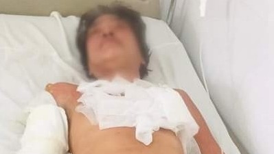Người sống sót vụ cháy nhà bị sốc và bỏng độ 2