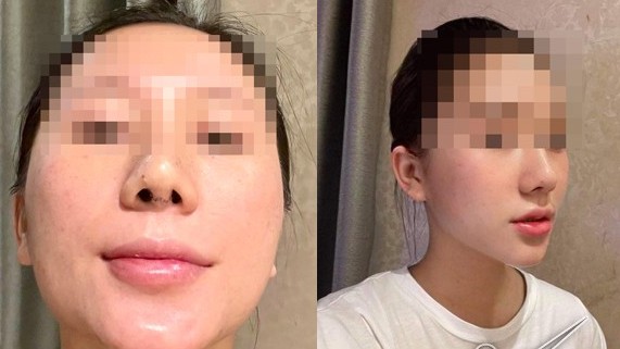 Bác sĩ cắt sụn sườn nâng mũi vẹo cho cô gái Hà Nội