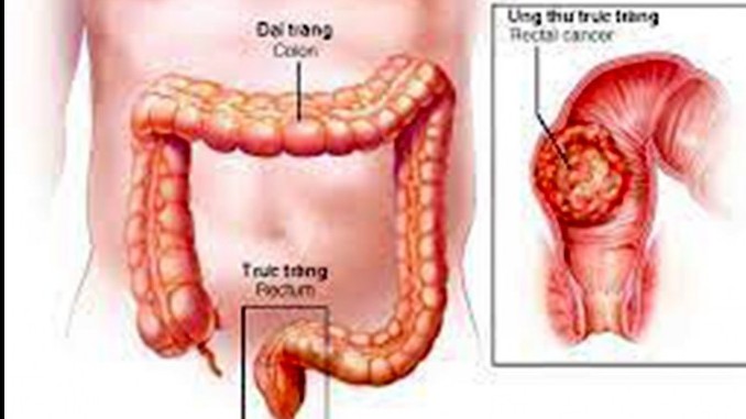 Dấu hiệu nào để nhận biết sớm ung thư đại trực tràng?