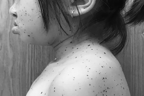 Bé gái đầu tiên ở Việt Nam mắc hội chứng da báo Bé gái đầu tiên ở Việt Nam mắc hội chứng da báo