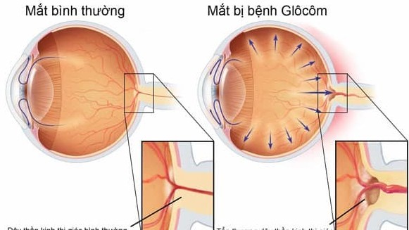 Bệnh Glaucom (Thiên đầu thống)