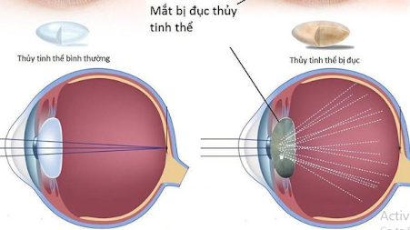 Bệnh đục thuỷ tinh thể