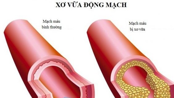 Bệnh xơ vữa động mạch