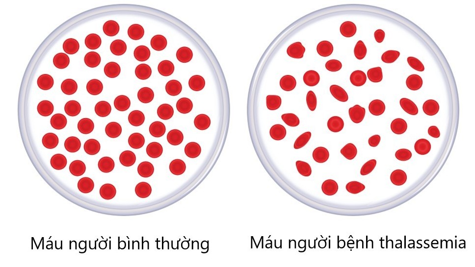 Làm thế nào để tránh cho con của bạn bị Thalassemia?