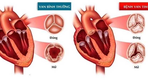 Tìm ra phương pháp thay van tim mới an toàn hơn