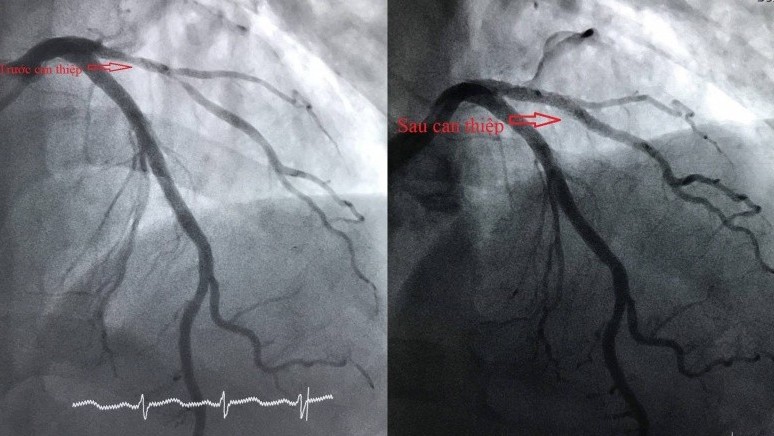 Cứu sống bệnh nhân bị nhồi máu cơ tim cấp